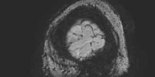 File:Cavernous hemangioma of the cerebellar falx (Radiopaedia 73025-83724 Sagittal BOLD 10).jpg