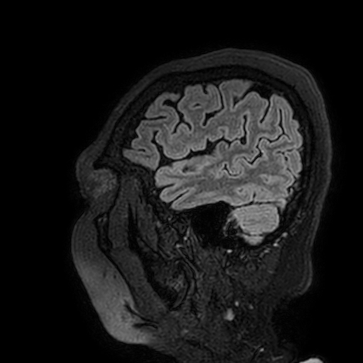 Cavernous hemangioma of the cerebellar falx (Radiopaedia 73025-83724 Sagittal FLAIR 186).jpg