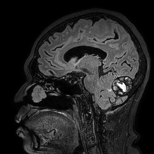 File:Cavernous hemangioma of the cerebellar falx (Radiopaedia 73025-83724 Sagittal FLAIR 92).jpg