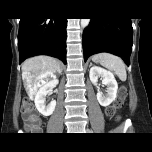 Cavernous hepatic hemangioma (Radiopaedia 75441-86667 C 94).jpg
