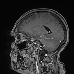 Cavernous sinus meningioma (Radiopaedia 63682-72367 Sagittal T1 C+ 109).jpg