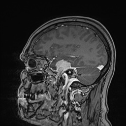 Cavernous sinus meningioma (Radiopaedia 63682-72367 Sagittal T1 C+ 62).jpg