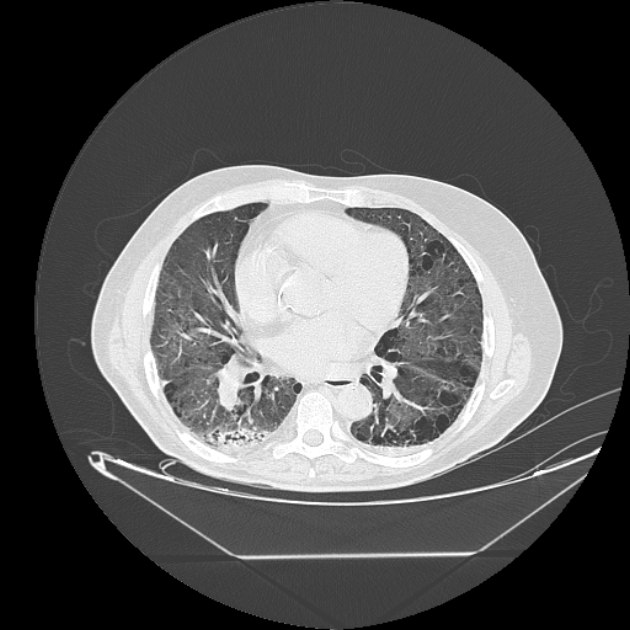 Cavitating bronchogenic carcinoma (Radiopaedia 44489-48162 Axial lung window 50).jpg
