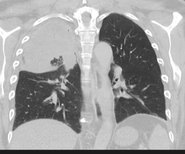 Cavitating pneumonia (Radiopaedia 45998-50329 Coronal lung window 32).png