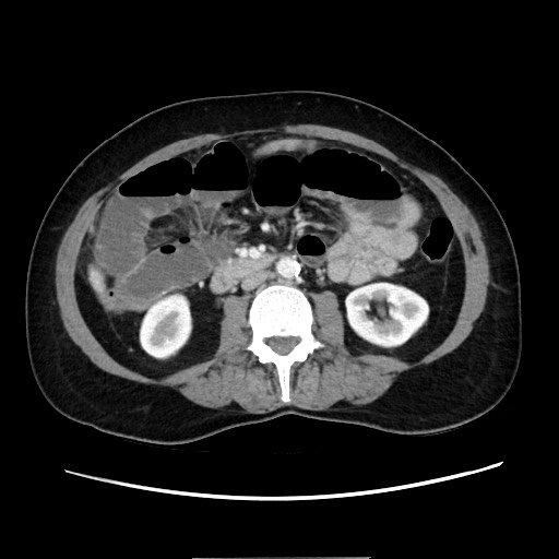 File:Cecal adenocarcinoma (Radiopaedia 75909-87331 A 46).jpg
