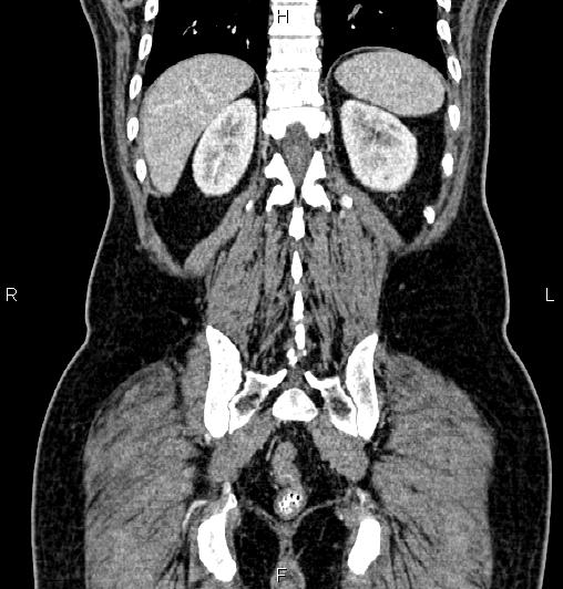 File:Cecal adenocarcinoma (Radiopaedia 85324-100916 D 54).jpg