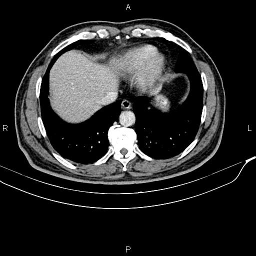 File:Cecal cancer with appendiceal mucocele (Radiopaedia 91080-108651 B 15).jpg