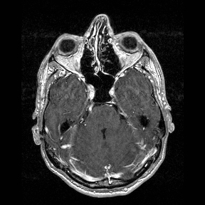 File:Central-variant posterior reversible encephalopathy syndrome (PRES) (Radiopaedia 43880-47358 Axial T1 C+ 42).jpg