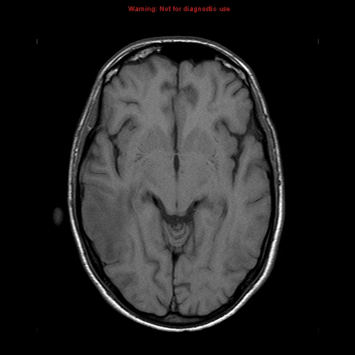 File:Central nervous system vasculitis (Radiopaedia 8410-9235 Axial T1 11).jpg