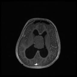 Central neurocytoma (Radiopaedia 30220-30842 Axial T1 C+ 87).jpg