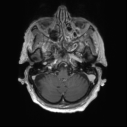 Central neurocytoma (Radiopaedia 65317-74345 Axial T1 C+ 5).png