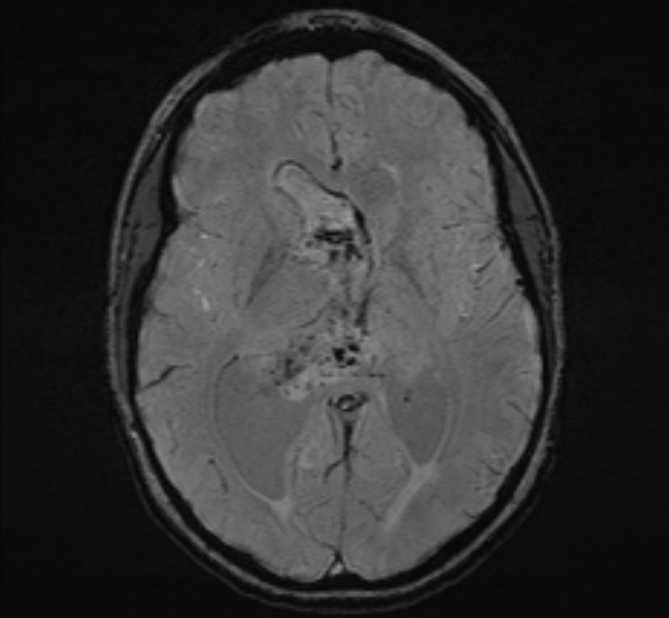 Central neurocytoma (Radiopaedia 70263-80336 Axial SWI 29).jpg