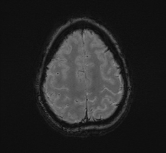 Central neurocytoma (Radiopaedia 70263-80336 Axial SWI 50).jpg