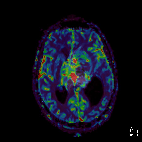 Central neurocytoma (Radiopaedia 84497-99872 Axial Perfusion 153).jpg