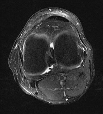 File:Central osteophyte (Radiopaedia 72592-83150 Axial PD fat sat 20).jpg