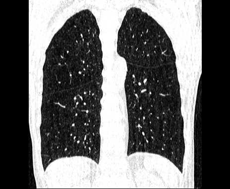 Centrilobular pulmonary emphysema (Radiopaedia 62468-70718 Coronal lung window 52).jpg