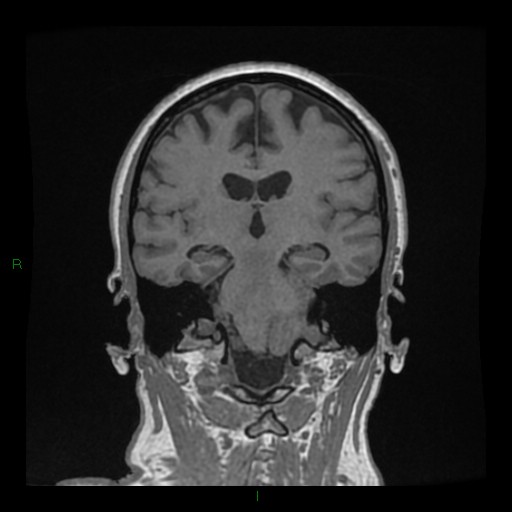 Cerebellar abscess (Radiopaedia 78135-90678 Coronal T1 C+ 93).jpg