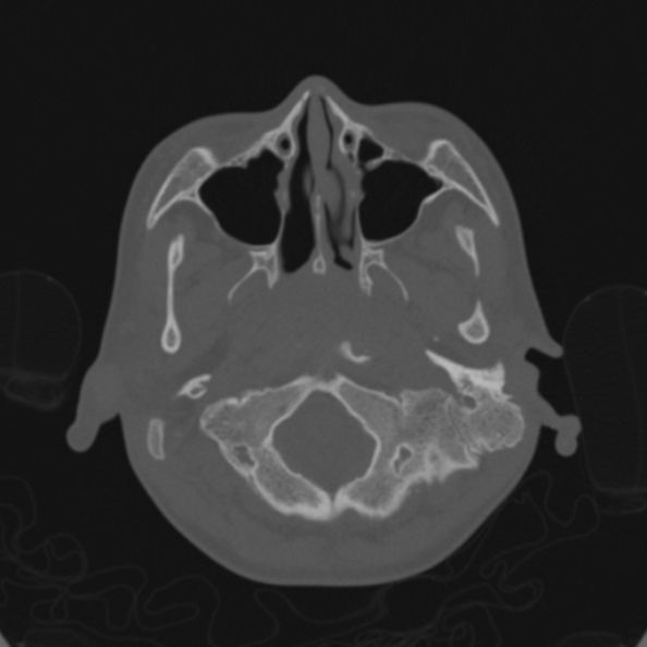 File:Cerebellar abscess secondary to mastoiditis (Radiopaedia 26284-26413 Axial bone window 20).jpg