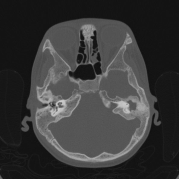 Cerebellar abscess secondary to mastoiditis (Radiopaedia 26284-26413 Axial bone window 55).jpg