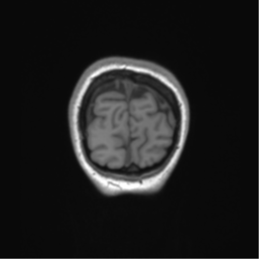 Cerebellar agenesis with hypoplastic pons (pontocerebellar hypoplasia) (Radiopaedia 57224-64138 Coronal T1 11).png