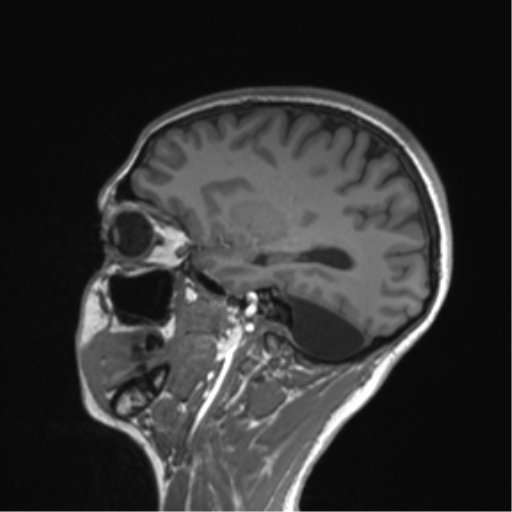 File:Cerebellar agenesis with hypoplastic pons (pontocerebellar hypoplasia) (Radiopaedia 57224-64138 Sagittal T1 25).png