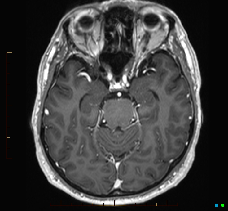 Cerebellar gangliocytoma (Radiopaedia 65377-74422 Axial T1 C+ 45).jpg