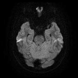 Cerebellar hemangioblastoma (Radiopaedia 29570-30077 Axial DWI 10).jpg