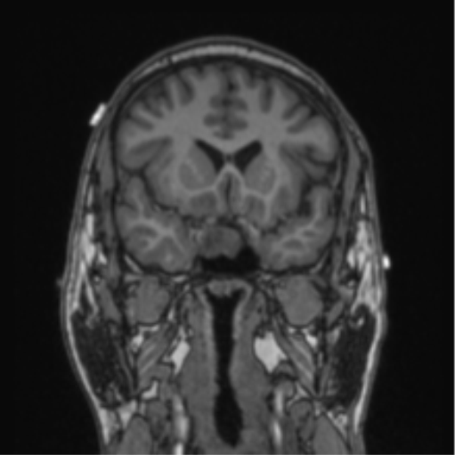 Cerebellar hemangioblastomas and pituitary adenoma (Radiopaedia 85490-101176 Coronal T1 60).png