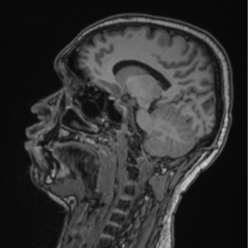 Cerebellar hemangioblastomas and pituitary adenoma (Radiopaedia 85490-101176 Sagittal T1 47).png