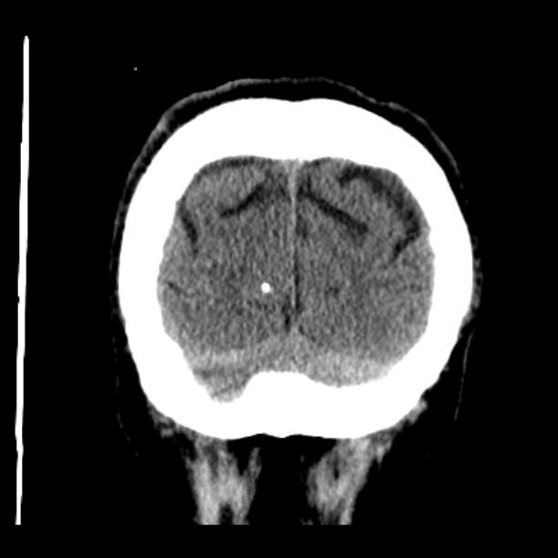 Cerebellar hemorrhage (Radiopaedia 27193-27359 Coronal non-contrast 51).jpg