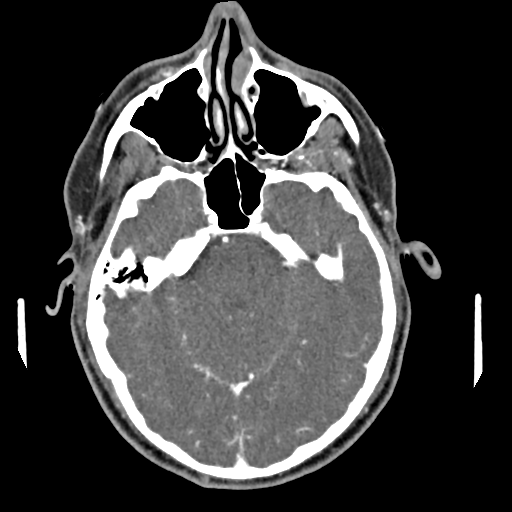 Cerebellar infarct due to vertebral artery dissection with posterior fossa decompression (Radiopaedia 82779-97029 C 4).png