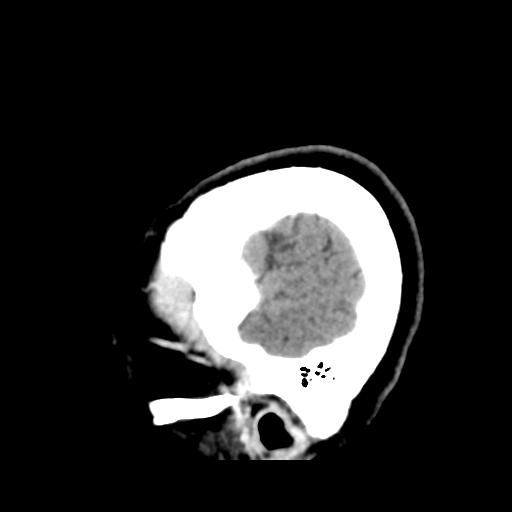 Cerebellar metastasis (cystic appearance) (Radiopaedia 41395-44258 F 47).png