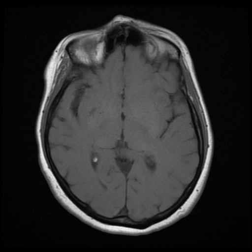 File:Cerebellar metastasis (cystic appearance) (Radiopaedia 41395-44268 Axial T1 12).png