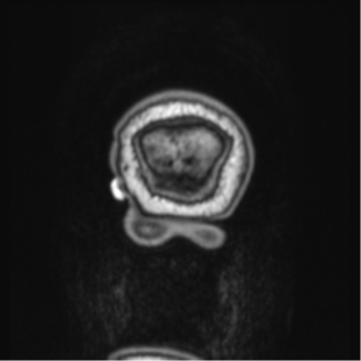 Cerebellar metastasis from lung adenocarcinoma (Radiopaedia 86690-102829 Coronal T1 2).png