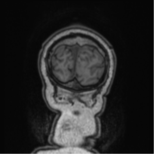 Cerebellar metastasis from lung adenocarcinoma (Radiopaedia 86690-102829 Coronal T1 8).png