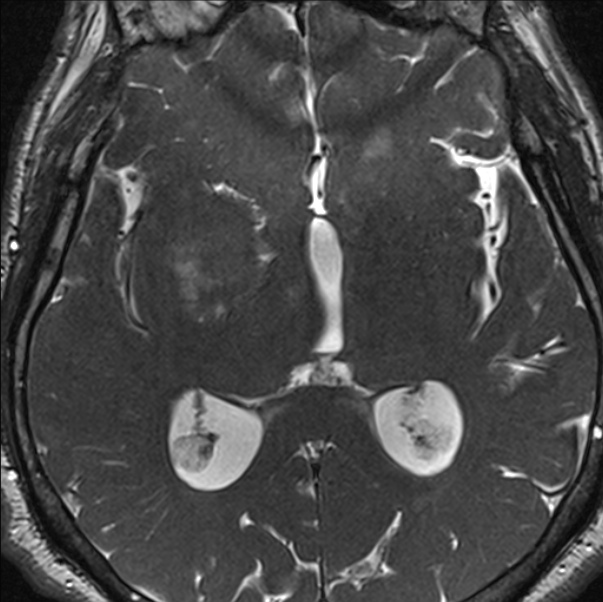 Cerebellopontine angle meningioma (Radiopaedia 24459-24764 I 53).jpg