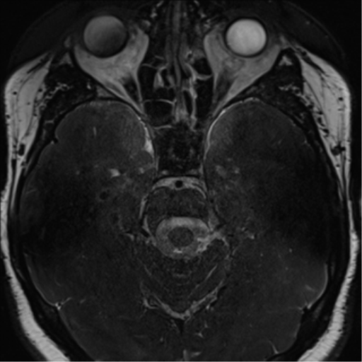 Cerebellopontine angle meningioma (Radiopaedia 48434-53348 Axial T2 Space 87).png