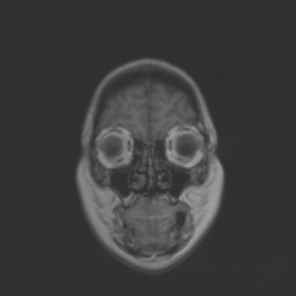 File:Cerebellopontine angle meningioma (Radiopaedia 53561-59591 Coronal T1 4).jpg