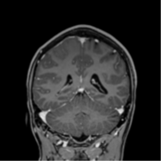 File:Cerebral abscess (Radiopaedia 60342-68009 H 14).png