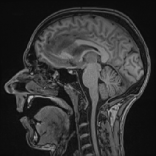 Cerebral abscess (Radiopaedia 60342-68009 Sagittal T1 28).png