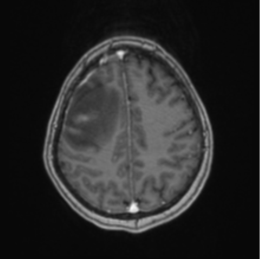 Cerebral abscess from pulmonary arteriovenous malformation (Radiopaedia 86275-102291 Axial T1 C+ 56).png