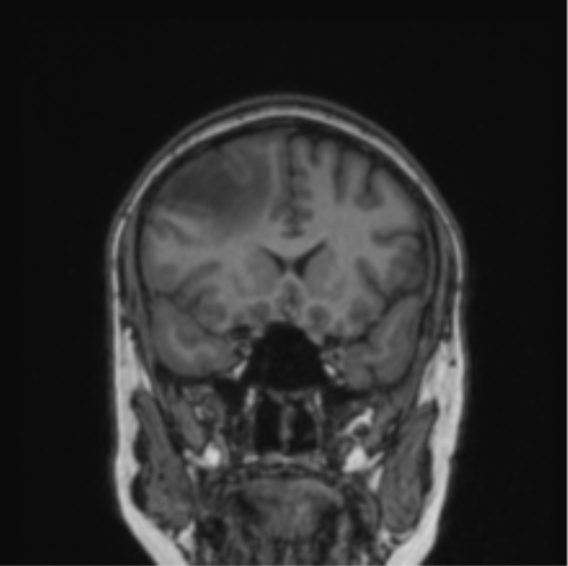 File:Cerebral abscess from pulmonary arteriovenous malformation (Radiopaedia 86275-102291 Coronal T1 61).png