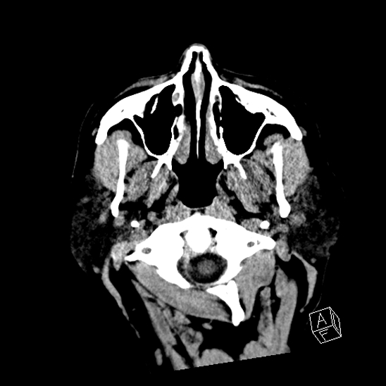 Cerebral abscess with ventriculitis (Radiopaedia 78965-91876 Axial non-contrast 1).jpg