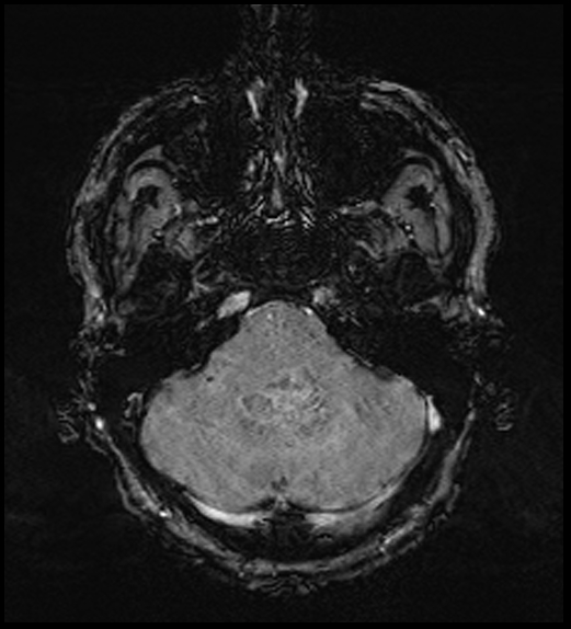 Cerebral abscess with ventriculitis (Radiopaedia 78965-91878 Axial SWI 14).jpg
