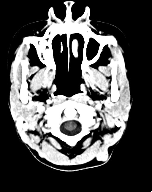 Cerebral abscesses (Radiopaedia 70458-80568 Axial Contrast 8).jpg