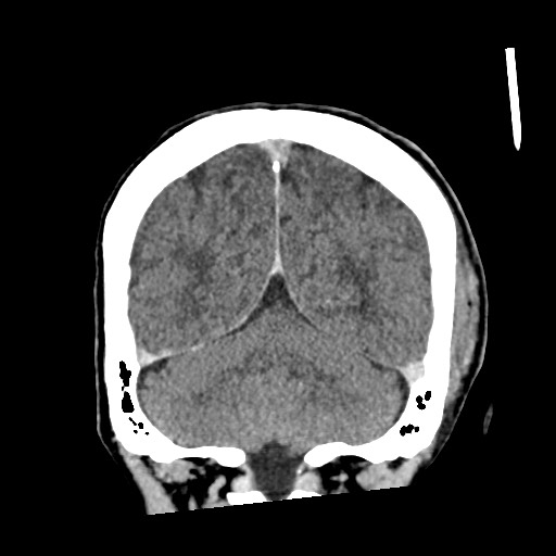 File:Cerebral amyloid angiopathy-related inflammation (Radiopaedia 74836-85848 Coronal non-contrast 54).jpg