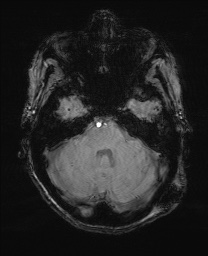 File:Cerebral amyloid angiopathy-related inflammation (Radiopaedia 74836-85849 Axial SWI 19).jpg