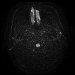 Cerebral amyloid angiopathy (Radiopaedia 28698-28978 Axial DWI 1).jpg
