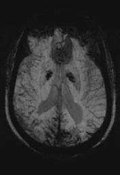 File:Cerebral amyloid angiopathy (Radiopaedia 29129-29518 Axial SWI MIP 17).jpg