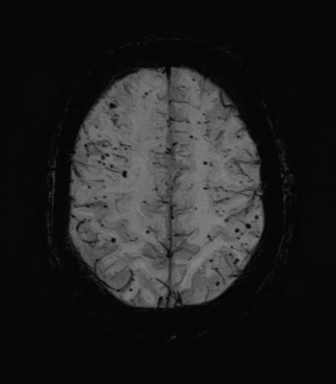 Cerebral amyloid angiopathy (Radiopaedia 46082-50433 Axial SWI MIP 61).png